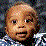 Tay-Sachs Disease