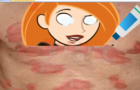 Cure Kim Possibles Lepracy